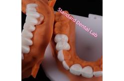 China Lithium Dicilicate layer Ivoclar Emax Zirconia Laminate Veneers Translucent OEM ODM supplier