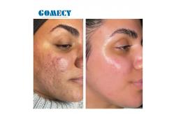 China GOMECY Microneedling Radiofrequency Machine , Microneedle Fractional RF System supplier