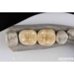 Emax Inlay Onlay Precise Fit And Hypoallergenic Biocompatibility Easy To Clean