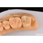 High Strength Emax Inlay Onlay A2 Color Long Lasting For Damaged Teeth Restoration for sale
