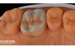 China Customizable Adhesive Zirconia Inlays Onlays High Translucency For Restoration supplier