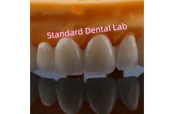 China Anterior Restoration Zirconia Bridge Crowns For Missing Teeth supplier