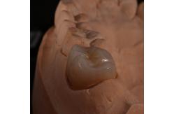 China Full Contour Translucent Zirconia Crown for Aesthetically Pleasing Results supplier