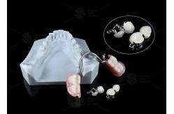 China Adjustable Multi Functional ERA Precision Attachment Removable ERA Attachments For Dentures supplier