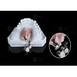 MK1 Precision Attachment Removable Partial Denture Easy Installation for sale