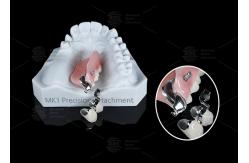 China MK1 Precision Attachment Removable Partial Denture Easy Installation supplier