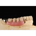 Elaborate Framework Final Set Stable Dental Structure Designed Teeth Finish