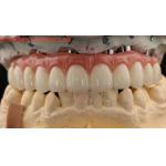 Porcelain All On Four Zirconia Bridge High Esthetics Dental Implant Bridge Screw Retained for sale
