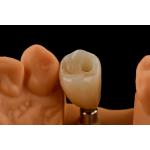 Titanium Single Tooth Dental Implants Internal Hex Connection Type For Optimal Fit for sale