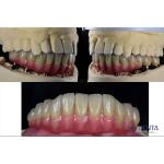 Dental Reconstruction Multiple Teeth Implant Titanium Prosthetic Connection Internal for sale