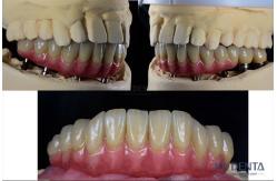 China Dental Reconstruction Multiple Teeth Implant Titanium Prosthetic Connection Internal supplier