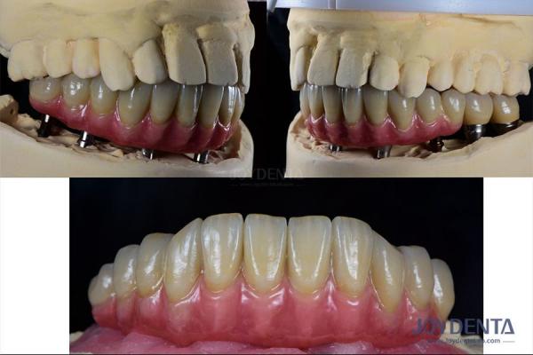 Dental Reconstruction Multiple Teeth Implant Titanium Prosthetic Connection Internal