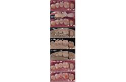 China Seamless Fit Porcelain Inlay Dental Procedure Customizable Shape For Teeth Repair supplier