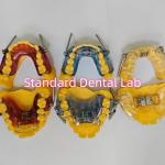 Dental Functional Orthodontic Herbst Appliances From China Dental Lab for sale