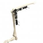 High Quality Orthopedic Surgical Instruments Knee Joint External Fixator External Fixation Orthopedic Surgical Instrumen for sale