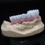 High Esthetics White Dental Crown Diagnostic Wax Up Customized China Dental Lab for sale