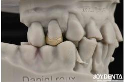 China Secure Cementation Emax Inlay Onlay Easy To Clean And Resistant To Staining supplier