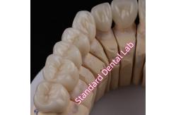 China Digital CAD CAM Dental Lab PFZ Crowns Translucent Layered Zirconia Crown supplier