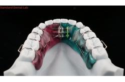 China Teeth Expansion And Distalization Orthodontist Palate Expander China Dental Lab supplier