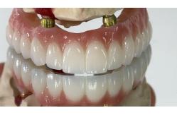 China Dental All On X Implant PFM Crown Titanium Fixed Hybrid Denture supplier