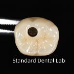 Screw Retained Dental Implant Crown for sale