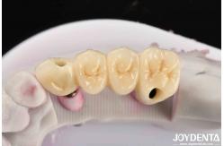 China Customizable Implant Crown And Bridge In Porcelain Precision For Perfect Function supplier