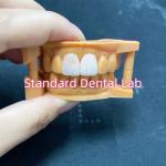 High Colour Stability Ivoclar Emax Laminate Veneers High Translucency for sale