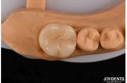 China polymerized porcelain Composite Inlay And Onlay Aesthetic And Durable Restorations supplier