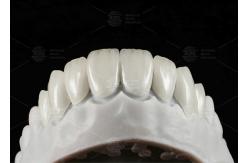 China Natural Pressed EMAX Veneer Strength 16 Shades Emax Teeth Veneers supplier