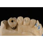 3.75mm Silver Titanium Screw Dental Implant Single Tooth Replacement Implant for sale
