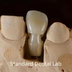 Dental Implant Tibase Zirconia Abutment Titanium Accuracy Customized for sale