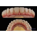 Rough Surface Dental Teeth Implant Platform Dental Bridges With Internal Connection for sale