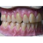 Hot Cured Full Arch Removable Acrylic Full Denture for sale