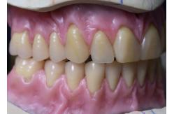 China Hot Cured Full Arch Removable Acrylic Full Denture supplier