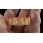 Porcelain All On Four Zirconia Bridge High Esthetics Dental Implant Bridge for sale