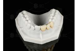 China Durable Hypoallergenic EMAX Bridge Extreme Esthetics Emax Dental Bridge supplier