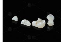China Translucent Onlay Zirconia Inlay For Long Lasting Stain And Wear Resistance supplier