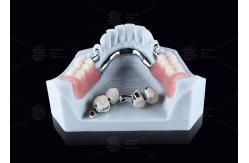 China CEKA M2 Precision Attachment Titanium With 3mm Horizontal / Vertical Clearances supplier
