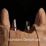 Dental Porcelain Zirconia Implant Crown Professional High Esthetics for sale