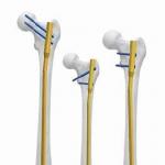 CE  11mm Intramedullary Plate Antibiotic Nail Femur for sale