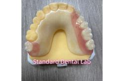 China OEM Removable Cast Tooth Shade Acrylic Partial Denture With Clasps supplier