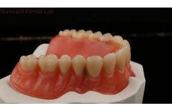 China Dentsply Lucitone 199 Acrylic Denture For Full Arch Natural Look supplier