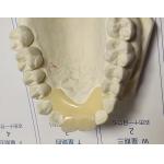 Soft Elastic Nylon Trushine Invisible Denture