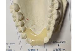 China Soft Elastic Nylon Trushine Invisible Denture supplier