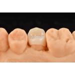 Customizable White Composite Inlay Onlay Natural Looking Minimally Invasive Tooth Restoration
