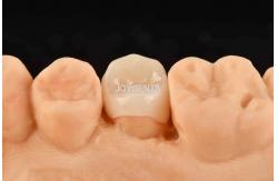 China Customizable White Composite Inlay Onlay Natural Looking Minimally Invasive Tooth Restoration supplier