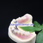 China Acrylic Metal Partial Denture Frameworks High Esthetics SDL dental lab manufacturer