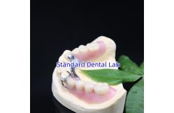 China Acrylic Metal Partial Denture Frameworks High Esthetics SDL dental lab supplier