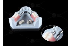 China 0.1mm Tolerance CEKA REVAX Attachment Titanium 3mm Vertical Clearance supplier