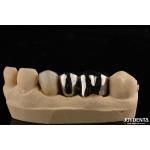 Abrasion Resistant Metal Alloy Crown For Customized Dental Restorations for sale